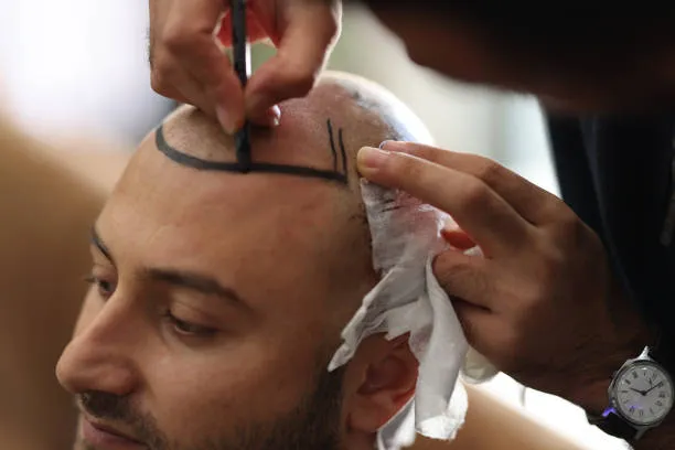 Hair Transplant Procedures for Effective Hair Regrowth