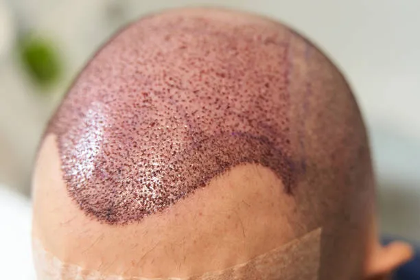 Personalizing Your Hair Transplant Plan for Perfection