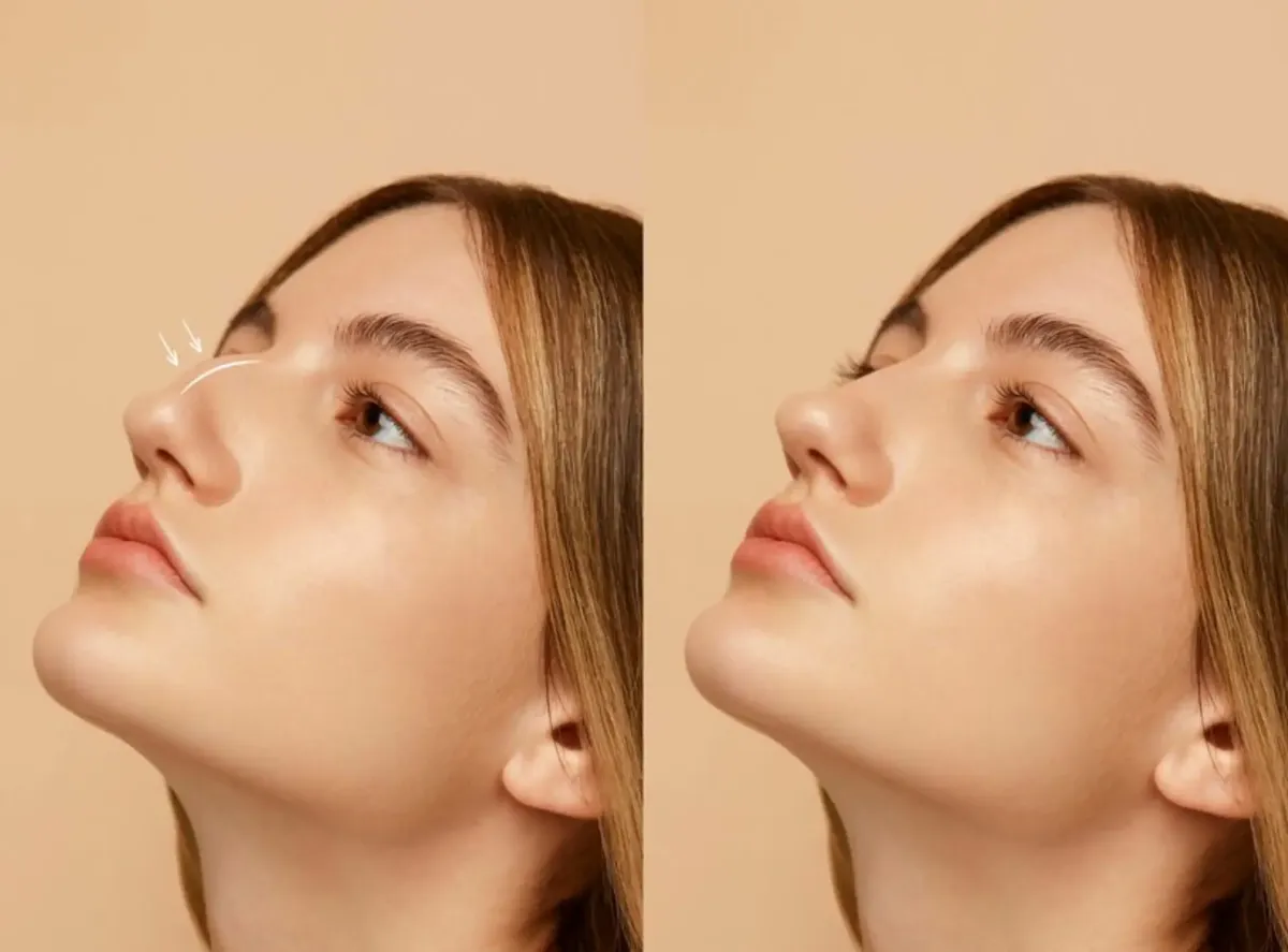Recovery Tips After Getting the Best Rhinoplasty in Dubai