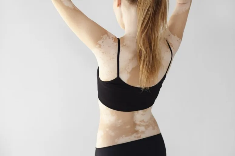 The Role of Individualized Homeopathic Prescriptions in Vitiligo Manag