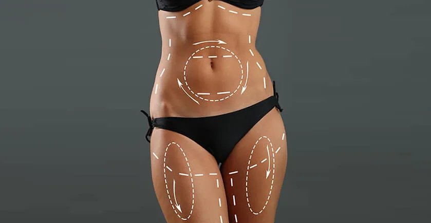 Liposuction Results Timeline: Week-by-Week Guide