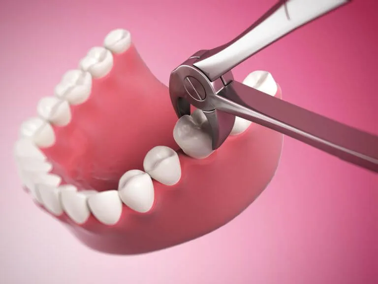 Wisdom Tooth Extraction Recovery Timeline at Dubai Clinics